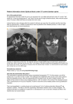 Patient information sheet: Epidural block under CT control (lumbar