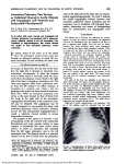 Anomalous Pulmonary Vein Serving as Collateral Channel in Aortic