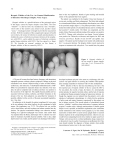 Herpetic Whitlow of the Toe: An Unusual Manifestation of Infection