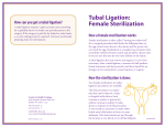 Tubal Ligation: Female Sterilization
