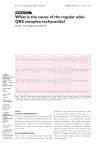 What is the cause of the regular wide QRS