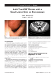 A 60-Year-Old Woman with a Cecal Lesion Seen on Colonoscopy