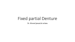Fixed partial Denture