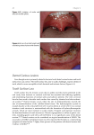 Dental Carious Lesions Tooth Surface Loss