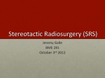 Stereotactic Radiosurgery