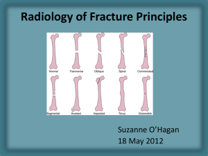 Recognizing an acute fracture