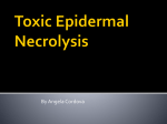 Toxic Epidermal Necrolysis