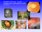 Herpes zoster ophthalmicus: shingles and the eye
