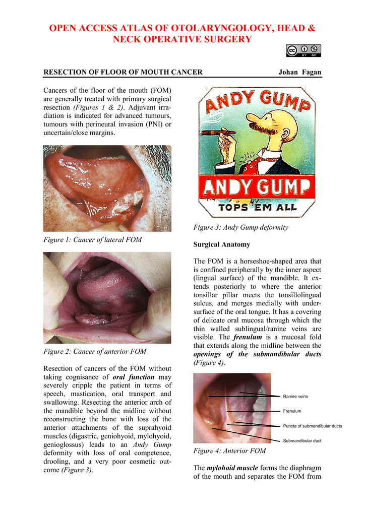 Floor Of Mouth Cancer Resection Vula