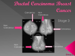 Ductal Breast Cancer
