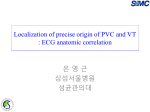 Localization of precise origin of PVC and VT : ECG anatomic