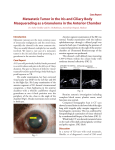 Metastatic Tumor in the Iris and Ciliary Body Masquerading as a