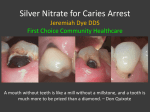 Silver Nitrate for arrest of dental caries