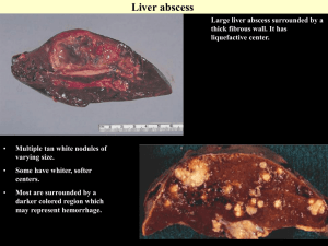 Liver abscess Large liver abscess surrounded by a thick fibrous wall