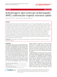 Arrhythmogenic right ventricular cardiomyopathy (ARVC