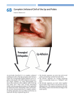 Complete Unilateral Cleft of the Lip and Palate