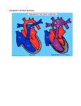 Hypoplastic Left Heart Syndrome