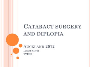 Cataract surgery and diplopia