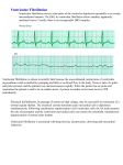 Ventricular_Fibrillation
