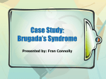Brugada`s Syndrome