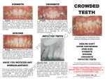 Crowded Teeth - Rideau Orthodontic Mfg. Ltd.