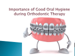 Importance of Good Oral Hygiene for people with Braces