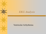 Ventricular Arrhythmias