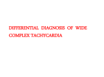 Differential diagnosis of broad complex tachycardia