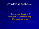 Arrythmias and EKGs