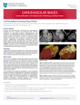 Left Circumflex to Coronary Sinus Fistula