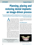 Planning, placing and restoring dental implants
