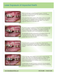 Laser Exposure of Impacted Teeth