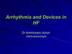 Arrhythmias and EKGs