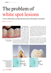 The problem of white spot lesions