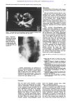 on the tricuspid valve. Though infective in diagnosing - Heart