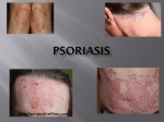 psoriasis