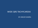 WIDE QRS TACHYCARDIA DR ANKUR