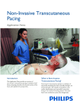 Non-Invasive Transcutaneous Pacing