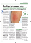 Cellulitis: what you ought to know