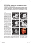 aortopulmonary window: a rare congenital heart disease acebdf