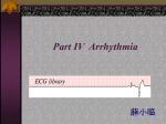 sinus arrhythmia