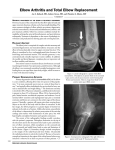 elbow Arthritis and total elbow Replacement