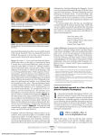 Cystic Epithelial Ingrowth in a Case of Deep Anterior Lamellar