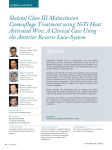 Skeletal Class III Malocclusion Camouflage Treatment using NiTi