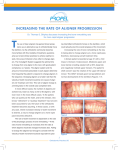 the use of propel to increase the rate of aligner progression