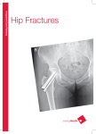Hip Fractures - JurongHealth
