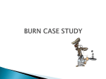 3B_Burns Case Study Presentation_Esson