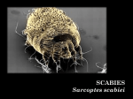 Scabies