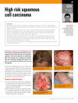 High risk squamous cell carcinoma