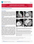 Supravalvular Aortic Stenosis - Massachusetts General Hospital